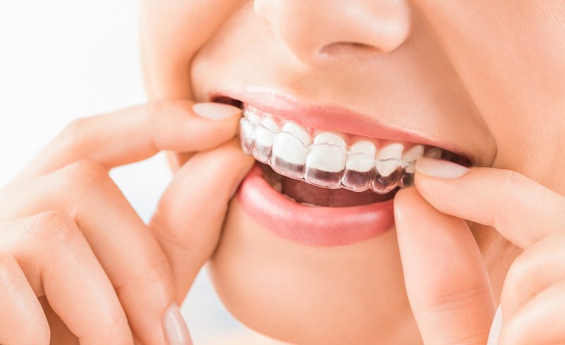 clear aligner ad